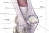 Intr-articular dislocation of patella